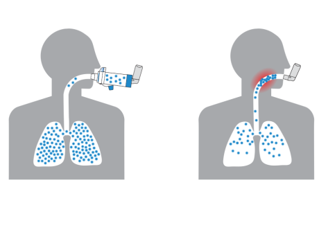 Lung deposition illustration with and without spacer